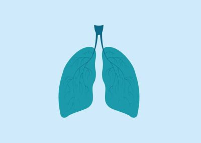 Going smoke-free to help reduce risk of lung cancer
